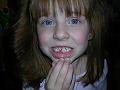 Keely's first missing tooth
